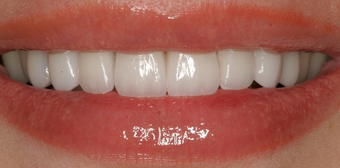 Porcelain Veneers After