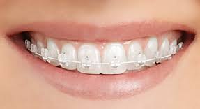 Teeth with clear bracket braces
