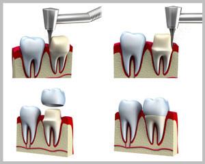 Dental Crown Installation Process