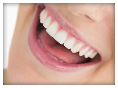 Woman Smiling With Veneers