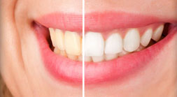 Teeth Whitening Illustration