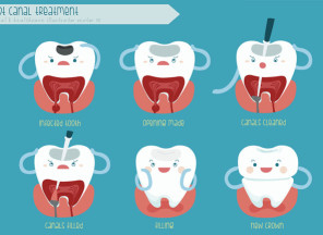 Root Canal Treatment Illustration