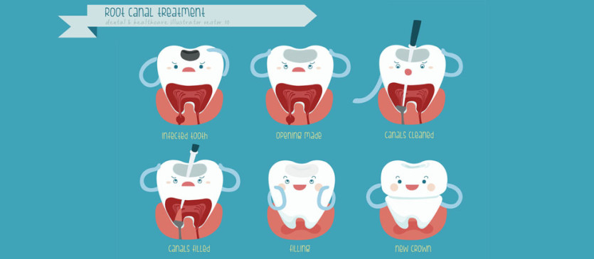 Root Canal Treatment Illustration