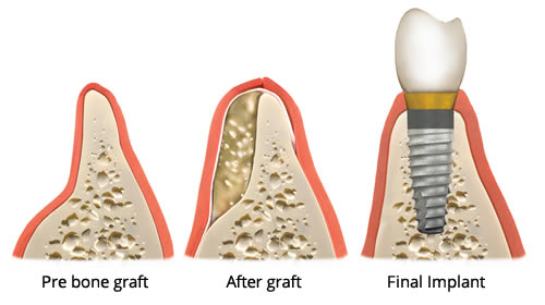 bone-graft-illustration