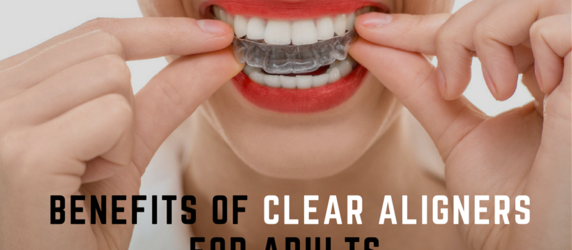 Benefits of Clear Aligners for Adults